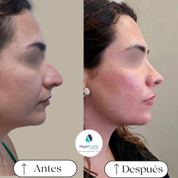 Slider image (5) Dra. Renata Cardenas-Aesthetic & Fuctional Rhinoplasty